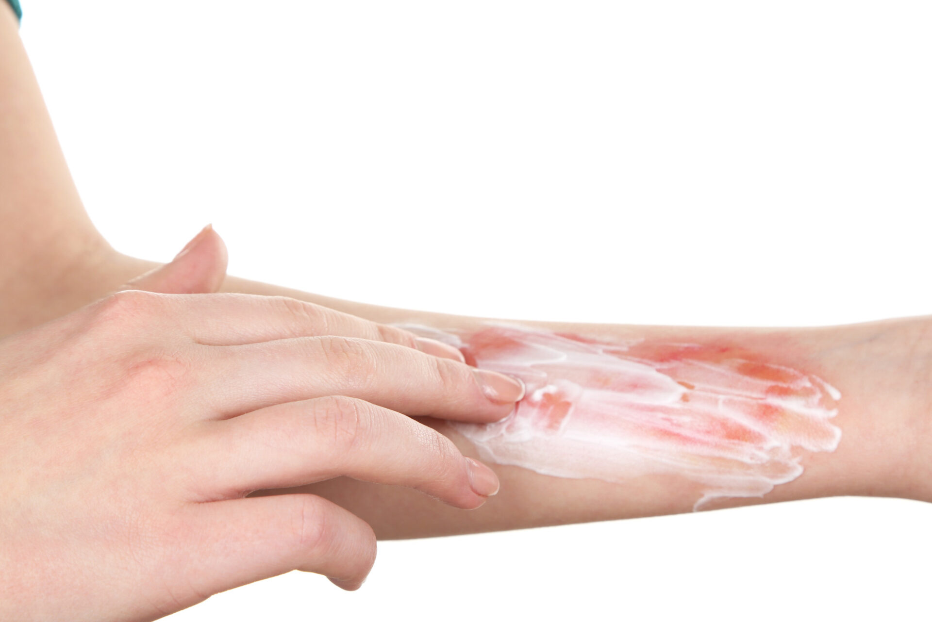 A Doctor’s Guide for Burn Wound Care (Do THIS Right Away)
